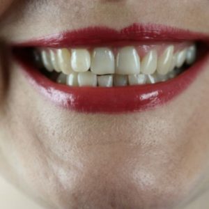 Diskolorasi Gigi: Jenis, Pengobatan, Pencegahan
