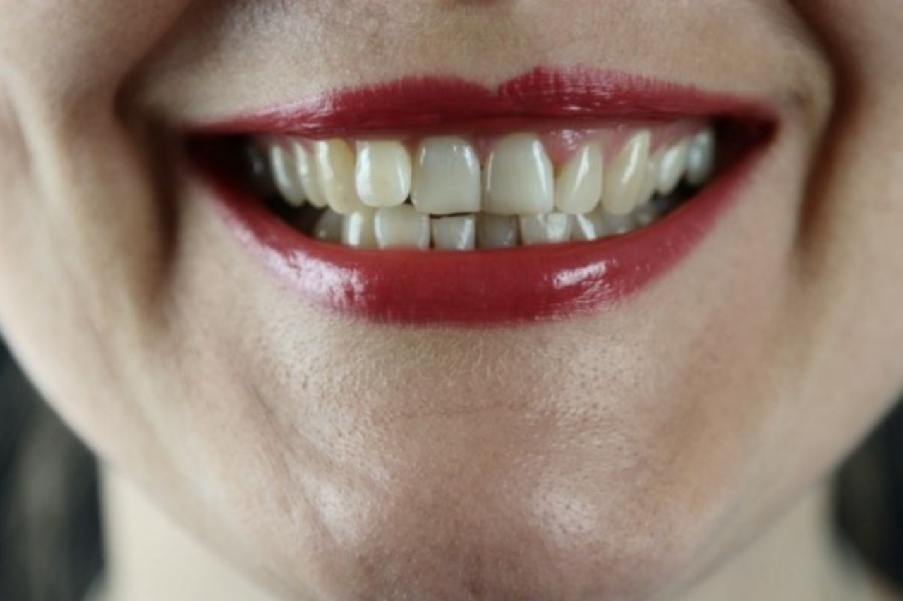 Diskolorasi Gigi: Jenis, Pengobatan, Pencegahan